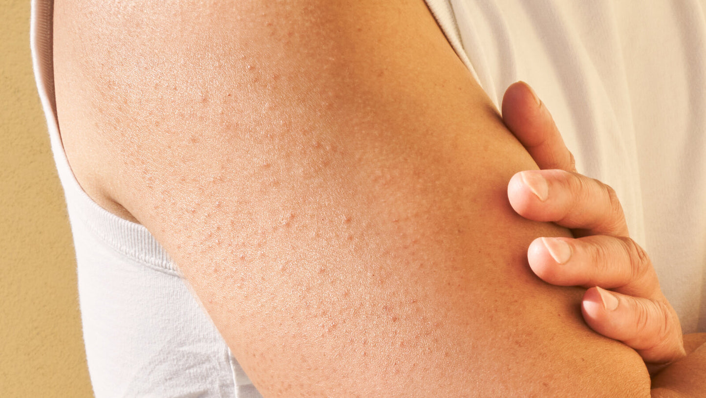 EPICUTIS® Lipid Body Treatment