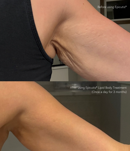 EPICUTIS® Lipid Body Treatment